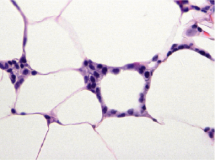 Crown-like structures in breast adipose tissue